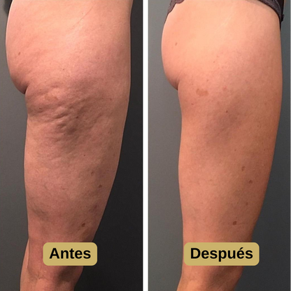 DERMALUX™ Masajeador Anticelulítico